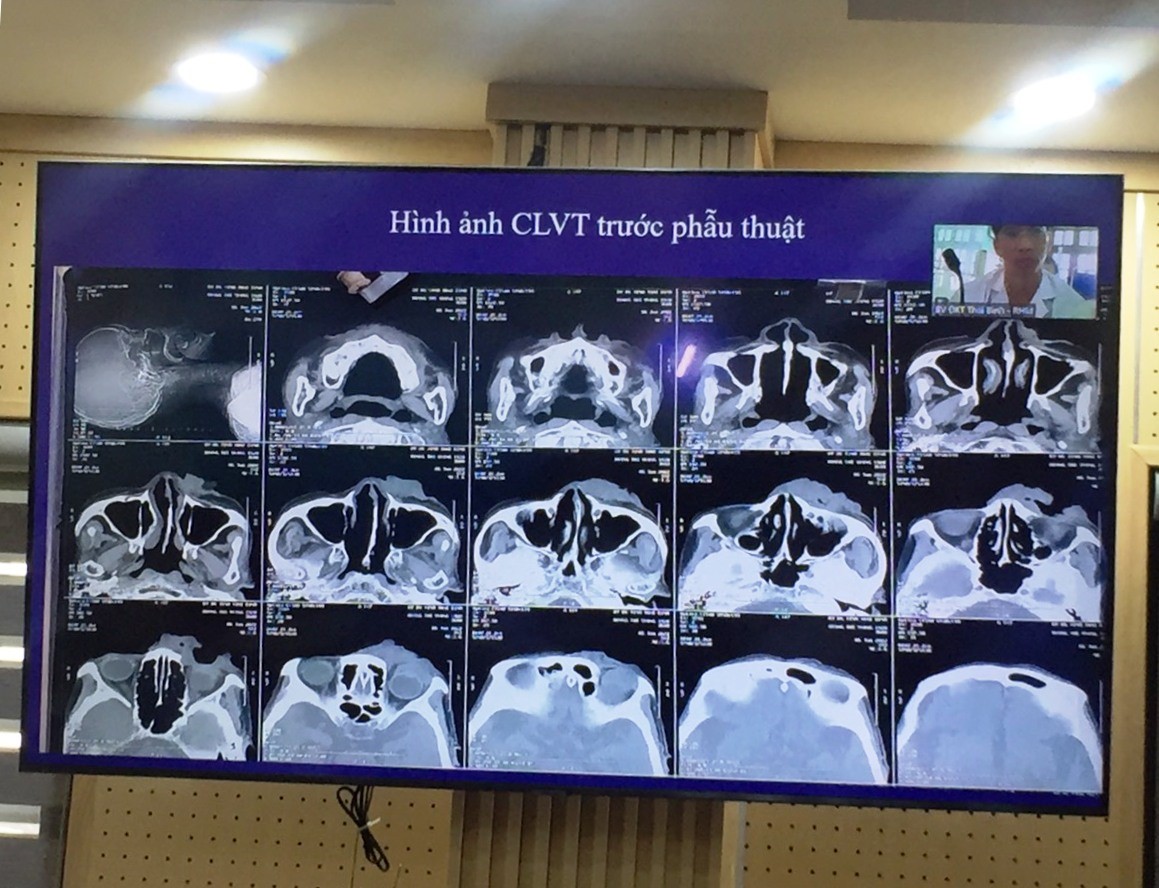 Hình ảnh trên phim CT Scanner ca bệnh thứ nhất